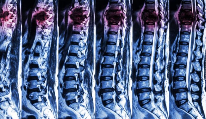 1-leziuni-coloana-123rf