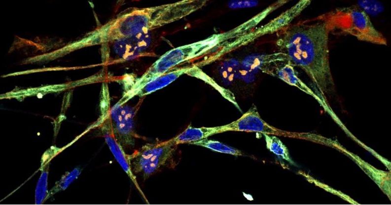 Incredibil! Celulele canceroase se transformă în celule sănătoase!